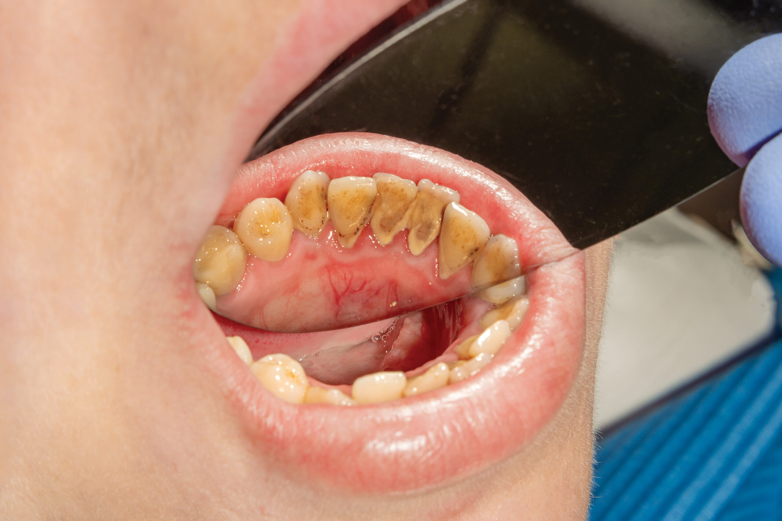 苫小牧　歯医者　歯石が付着しやすい　千秋歯科医院