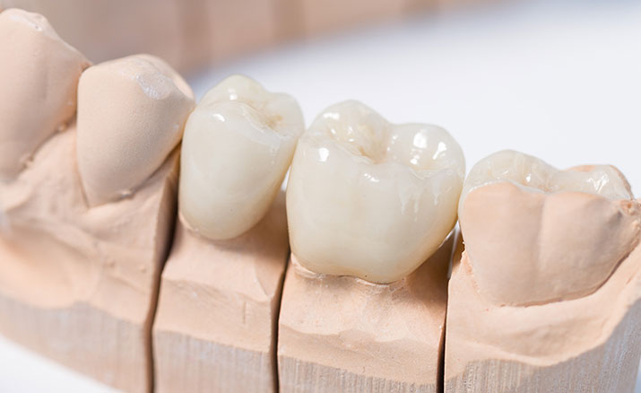 セラミック治療が向いている人、向いていない人